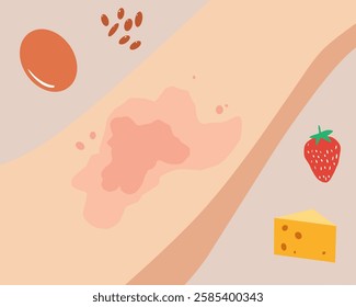 Vector illustration of an allergic reaction on the skin, showing red rashes and irritation. One version includes common allergenic foods like nuts, strawberries, cheese, and eggs. Useful for medical, 