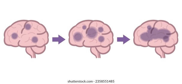 Vector illustration of Alzheimer's dementia. brain