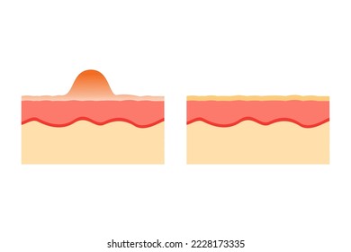 vector illustration of an anatomy comparison of healthy and acne-prone skin. epidermis and desmis of the skin. illustration for skin medical science and health.