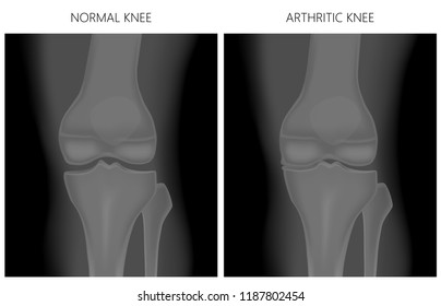 Vector illustration. Anatomy, front x-ray of a healthy knee joint and an arthritic knee. For advertising and medical publications. EPS 10.