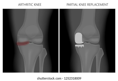 Vector illustration. Anatomy, front x-ray of an arthritic knee joint and a knee after unicompartmental or partial  knee replacement. For advertising and medical publications. EPS 10.