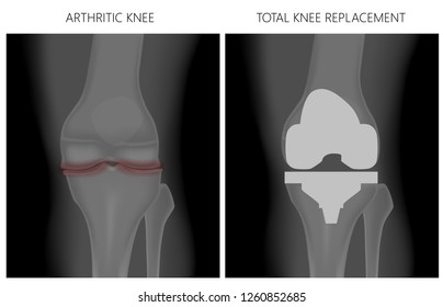 Vector Illustration Anatomy Front Xray Arthritic Stock Vector (Royalty ...