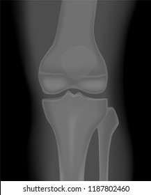 Vector illustration. Anatomy of a healthy knee joint, front x-ray of the knee. For advertising and medical publications. EPS 10.
