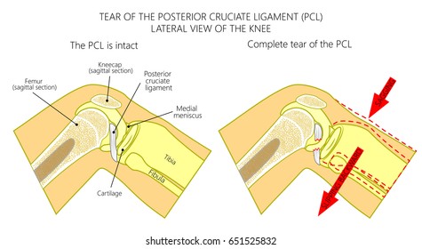 Vector illustration anatomy of a knee joint with healthy and torn posterior cruciate ligament. Side or lateral view of flexed knee with sagittal section of femur bone. For medical publications. EPS 10