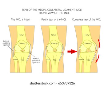 Vector illustration anatomy of a knee joint with healthy ligaments and sprain, tear or rupture of medial collateral ligament. Front view of straight knee. For advertising, medical publications. EPS 10