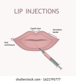  Vector illustration of anatomy of lips in flat style . Info graphic of lip injections on white background .Lip Augmentation.