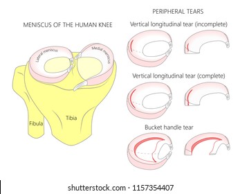  Vektorgrafik. Anatomie eines Meniskus im gesunden menschlichen Kniegelenk. Periphere Menisekräne mit Querschnitt der Meniski. Für die Werbung, medizinische Veröffentlichungen. EPS10.