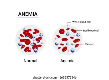 Vector illustration of anemia and normal amount of red blood cells.