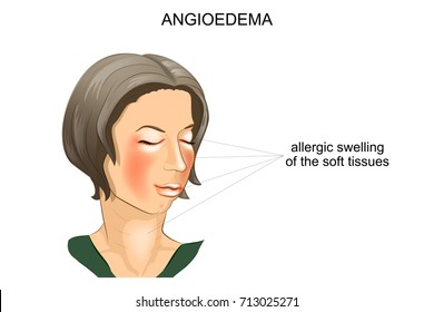 vector illustration of angioedema. allergic swelling of the soft tissues of the face
 svg