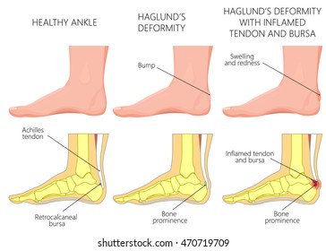 Vector Illustration of an ankle (side view) with Haglund's deformity, inflamed Achilles tendon and bursitis. Used: Gradient, transparency, gradient, blend, blend mode.