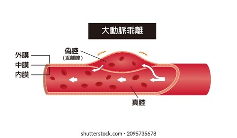 Ilustración vectorial de la disección aórtica (japonés).  Traducción: Disección aórtica, Adventitia, Medios, Intima, Falsa lumen, Verdadera lumen.
