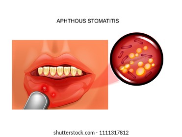 vector illustration of aphthous stomatitis. aphthae in the oral mucosa