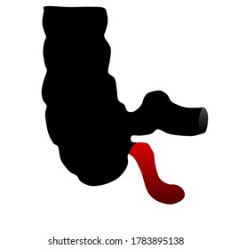 Vector illustration of Appendicitis. A medical term refer to Inflammation of the Appendix.