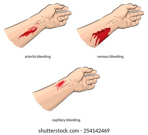 Vector illustration of Arterial and venous bleeding