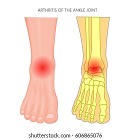 足首の関節炎のベクターイラスト 痛みを伴う人間の足の正面図 Eps10 のベクター画像素材 ロイヤリティフリー Shutterstock