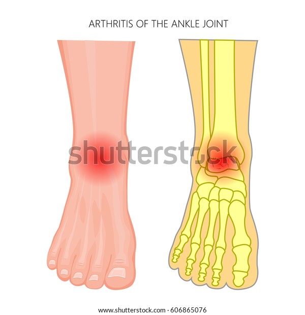 足首の関節炎のベクターイラスト 痛みを伴う人間の足の正面図 Eps10 のベクター画像素材 ロイヤリティフリー