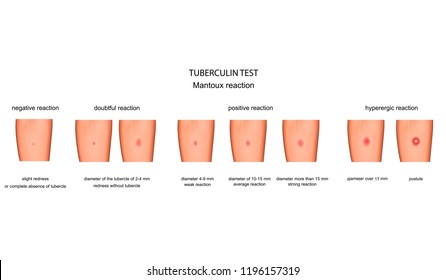 vector illustration of the assessment of reaction to a Mantoux test