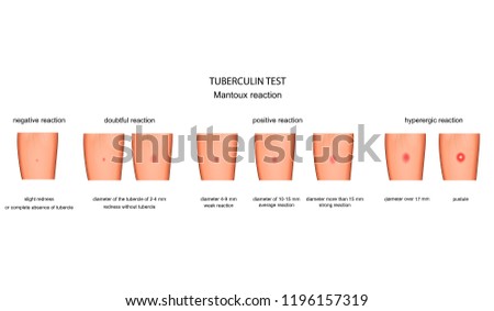 vector illustration of the assessment of reaction to a Mantoux test