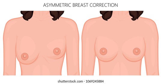 Vector illustration of asymmetric breast correction before and after plastic surgery. Front view of the woman chest. For advertising and medical publications. EPS 10.