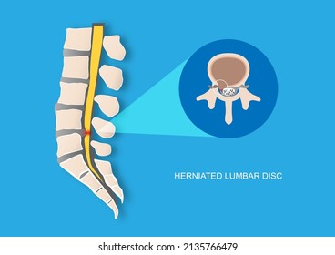 Ilustración vectorial del dolor de espalda causado por el disco vertebral lumbar hernificado. Protrusión del disco intervertebral que causa compresión de la raíz nerviosa.