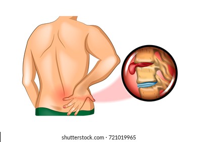 vector illustration of back pain. damage to the spine
