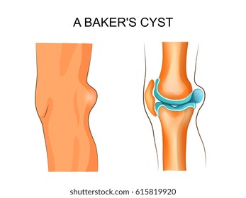 vector illustration of Baker's cyst. traumatology and orthopedics
