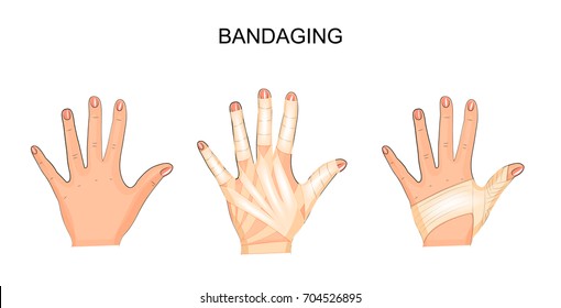 vector illustration of bandaging his hands. surgery
