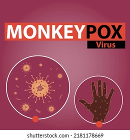 A Vector Illustration Banner Design For The Monkeypox Virus. Viral Zoonosis.  Illustration Of Hand With Itchy Rash. 