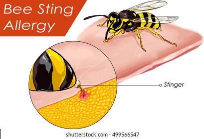  Vector illustration of a Bee sting allergy 