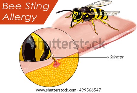  Vector illustration of a Bee sting allergy 