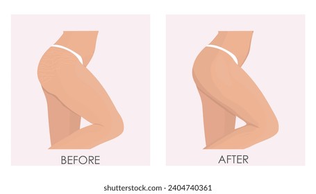 Vector illustration before and after of treatment of stretch marks and stretch marks using cosmetic and laser techniques. Female buttocks before and after treatment.