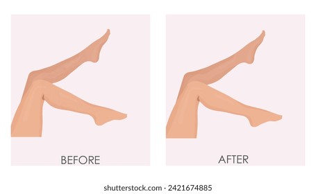Ilustración vectorial antes y después del tratamiento de marcas de estiramiento y de estiramiento utilizando técnicas cosméticas y láser. Nalgas hembras antes y después del tratamiento.