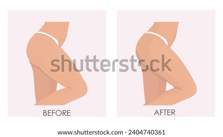 Vector illustration before and after of treatment of stretch marks and stretch marks using cosmetic and laser techniques. Female buttocks before and after treatment.