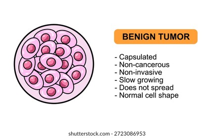 Ilustração vetorial de um tumor benigno Características de tumores benignos, não cancerosos. Ilustração para diagrama médico, elemento de design, cartaz ou treinamento.