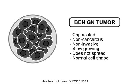 Ilustração vetorial de um tumor benigno Características de tumores benignos, não cancerosos. Ilustração para diagrama médico, elemento de design, cartaz ou treinamento.