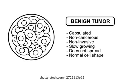 Ilustração vetorial de um tumor benigno Características de tumores benignos, não cancerosos. Ilustração para diagrama médico, elemento de design, cartaz ou treinamento.