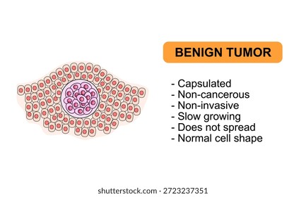 Ilustração vetorial de um tumor benigno Características de tumores benignos, não cancerosos. Ilustração para diagrama médico, elemento de design, cartaz ou treinamento.