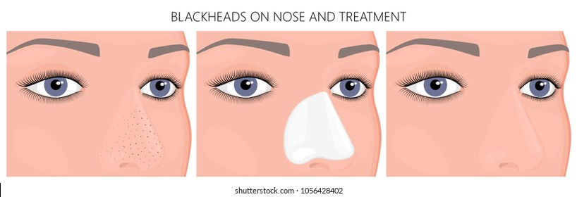 Vector illustration/ Blackheads on face problem (cheeks, nose) before, after treatment For placement on packaging of medicinal, pharmacy products, cream, lotion, cosmetic procedures advertising EPS 10