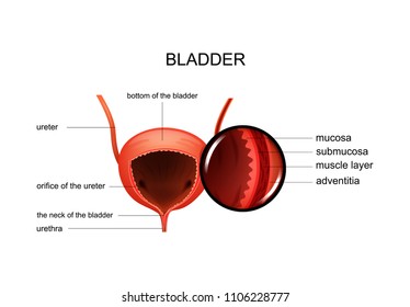 vector illustration of bladder inflammation caused by E. coli