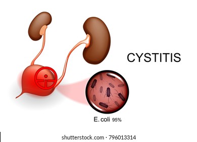 vector illustration of the bladder and kidneys. cystitis 