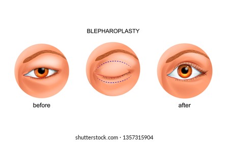 Vektorillustration-Illustration der Blinddarstellung des asiatischen Augenlids