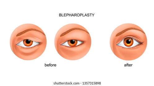 vector illustration of blepharoplasty of the overhanging eyelid and Asian eyelid