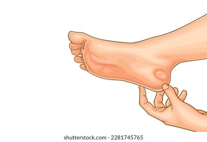 Vector illustration of blister on woman heel, heat blister with fluid inside, human barefoot heel burning swelling hurt pain, injuries, isolated on white background.Health care,Skin care feet.