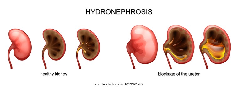 Hydronephrosis Images, Stock Photos & Vectors | Shutterstock