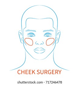 Vector illustration: blue contour hand drawn european male face plastic surgery icon with inscription Cheek surgery isolated on white background