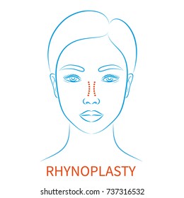 Vector illustration: blue contour hand drawn asian female face plastic surgery icon with inscription Rhynoplasty isolated on white background
