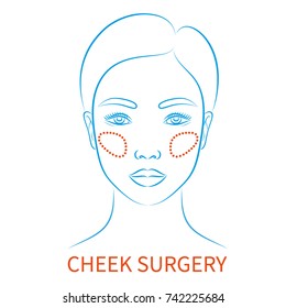 Vector illustration: blue contour hand drawn asian female face plastic surgery icon with inscription Cheek surgery isolated on white background
