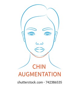 Vector illustration: blue contour hand drawn asian female face plastic surgery icon with inscription Chin augmentation isolated on white background