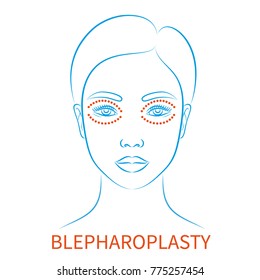Vektorgrafik: blaue Kontur handgezeichnet asiatisch weiblich Gesicht plastische Chirurgie Symbol mit Inschrift Blepharoplastik einzeln auf weißem Hintergrund
