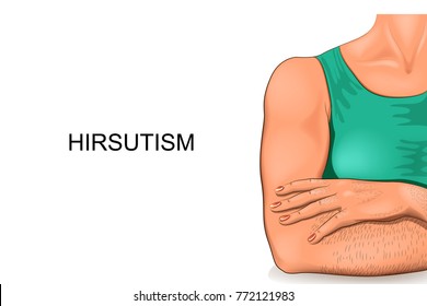 vector illustration of the body of women suffering from hirsutism